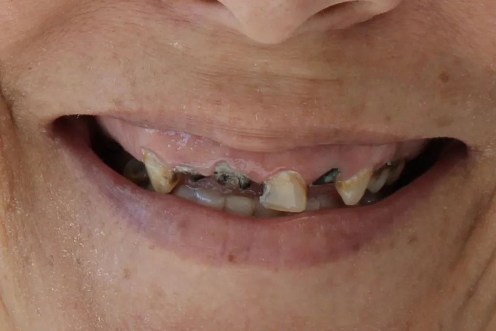 dental implant success story austin texas