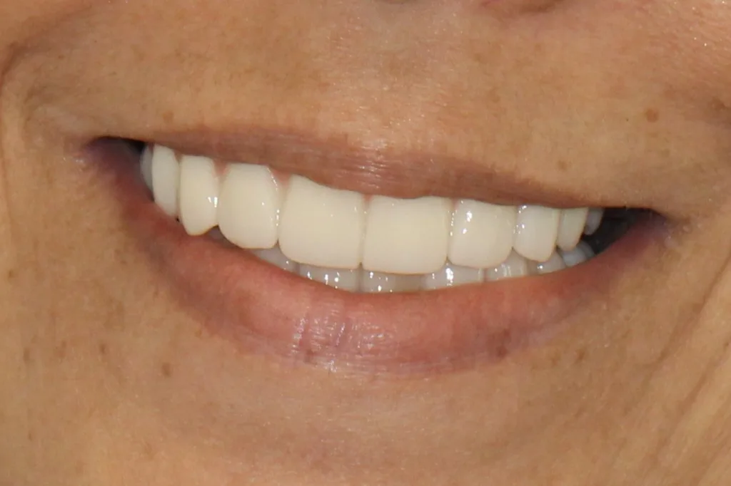 dental implants austin texas