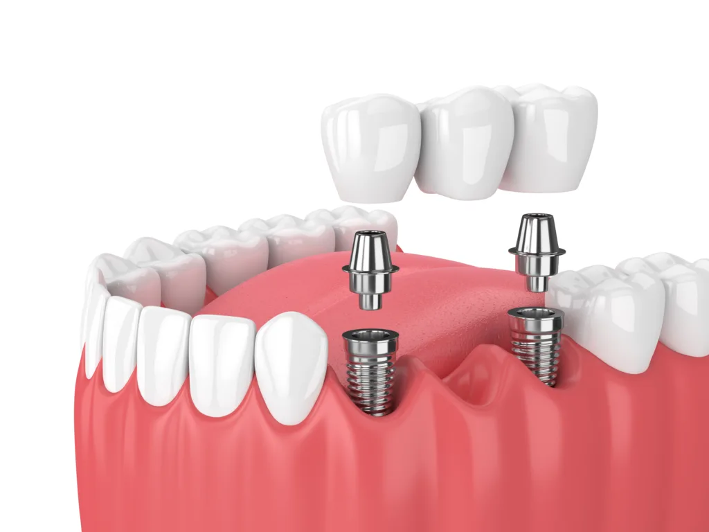 Explore Effective Solutions to Restore Missing Teeth missing teeth