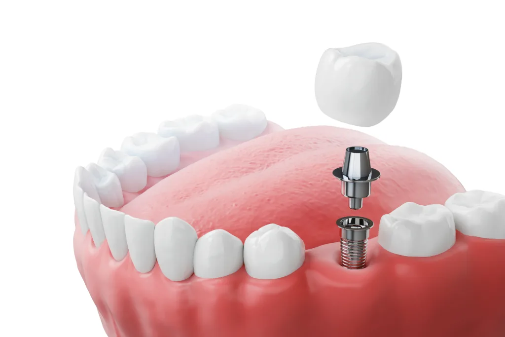 Explore Effective Solutions to Restore Missing Teeth missing teeth