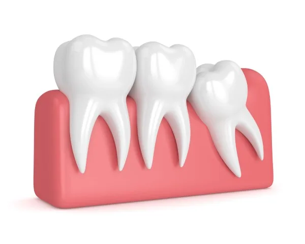 Worried About Wisdom Teeth Removal? What You Need To Know wisdom teeth removal smile solutions red rock tx
