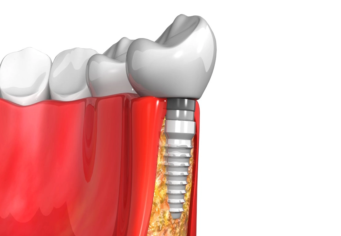 Understanding Dental Implant Failure: Causes, Signs, and Prevention Dental Implant Failure